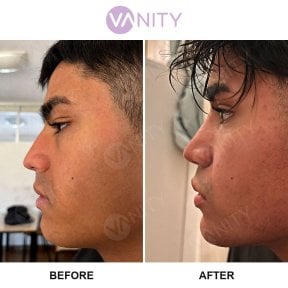 before-after photo rhinoplasty-nose-job