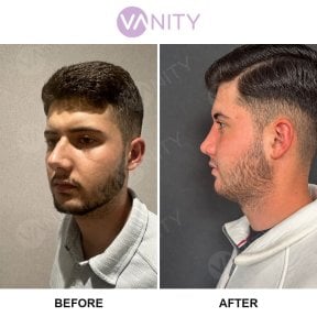 before-after photo rhinoplasty-nose-job