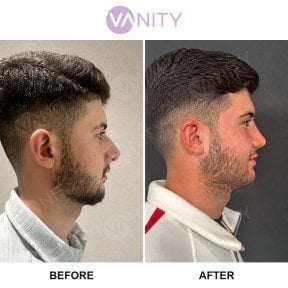 before-after photo rhinoplasty-nose-job