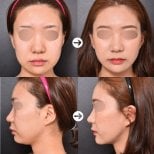 Результат липосакции второго подбородка до и после в VG Plastic Surgery, улучшен контур челюсти