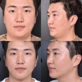 Before and after double chin liposuction at VG Plastic Surgery, visible jawline contour result