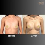 Before and after breast augmentation results at ID Clinic Bangkok, enhanced breast volume