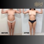 Before and after liposuction results at ID Clinic Bangkok, improved body contour and waistline