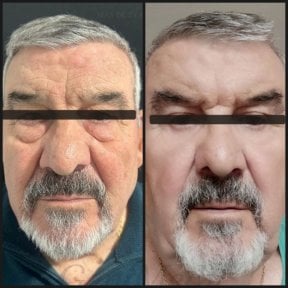 before-after photo blepharoplasty-eyelid
