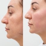Результати до і після Ultherapy в клініці Altos – помітне підтягнення шкіри обличчя