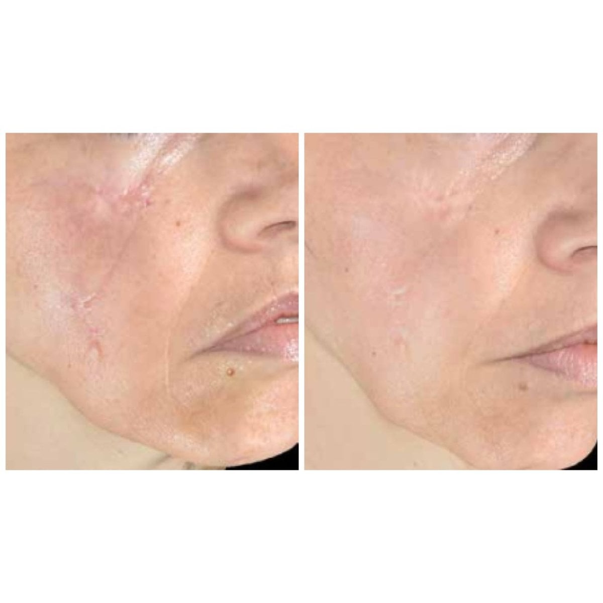 نتائج قبل وبعد تصحيح الندبات على الوجه في Altos Clinic، مظهر بشرة محسن