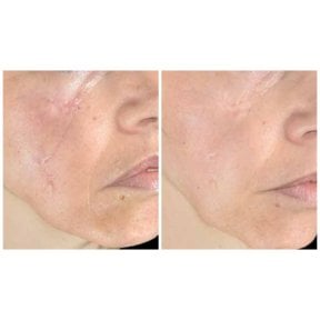 before-after photo scar-revision