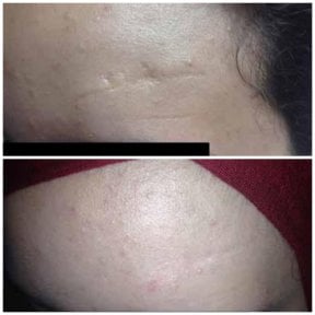 before-after photo scar-revision