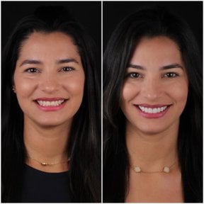 نتيجة قبل وبعد الفينير في DentVisit — Istanbul Dental Care، تجميل الابتسامة