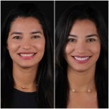 نتيجة قبل وبعد الفينير في DentVisit — Istanbul Dental Care، تجميل الابتسامة