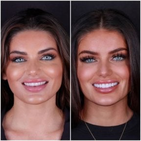 نتيجة قبل وبعد قشور الأسنان في DentVisit — Istanbul Dental Care، تجميل الابتسامة