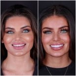 نتيجة قبل وبعد قشور الأسنان في DentVisit — Istanbul Dental Care، تجميل الابتسامة