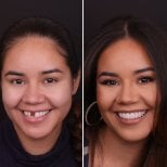 نتيجة قبل وبعد الفينير في DentVisit — Istanbul Dental Care، تحول الابتسامة