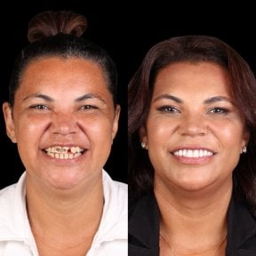 نتيجة قبل وبعد الفينير في DentVisit — Istanbul Dental Care، تحول الابتسامة