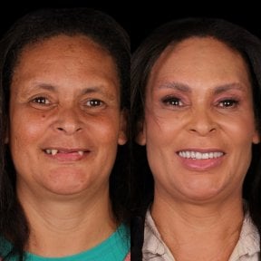 نتيجة قبل وبعد الفينير في DentVisit — Istanbul Dental Care، تحول الابتسامة