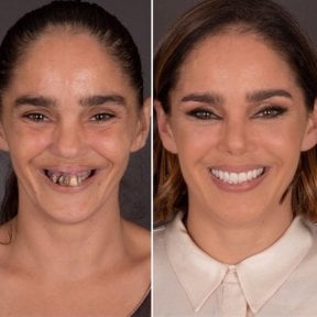 قبل وبعد قشور الأسنان في DentVisit — Istanbul Dental Care، نتيجة تحول الابتسامة