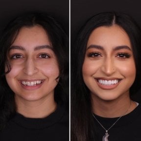 نتيجة قبل وبعد الفينير في DentVisit — Istanbul Dental Care، تحول الابتسامة