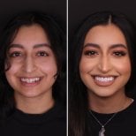 نتيجة قبل وبعد الفينير في DentVisit — Istanbul Dental Care، تحول الابتسامة