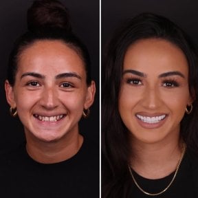 نتيجة قبل وبعد الفينير في DentVisit — Istanbul Dental Care، تحول الابتسامة