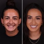 نتيجة قبل وبعد الفينير في DentVisit — Istanbul Dental Care، تحول الابتسامة