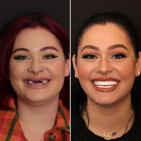 قبل وبعد الفينير في DentVisit — Istanbul Dental Care، نتيجة تجميل الابتسامة