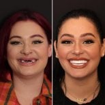 قبل وبعد الفينير في DentVisit — Istanbul Dental Care، نتيجة تجميل الابتسامة