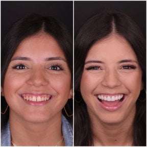 نتيجة قبل وبعد الفينير في DentVisit — Istanbul Dental Care، تحول الابتسامة