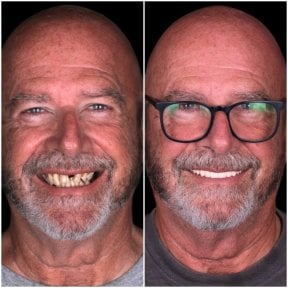 نتيجة قبل وبعد الفينير في DentVisit — Istanbul Dental Care، تجميل ابتسامة للرجال