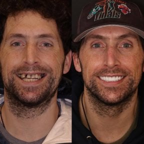 نتيجة قبل وبعد الفينير في DentVisit — Istanbul Dental Care، تجميل الابتسامة