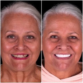 نتيجة قبل وبعد الفينير في DentVisit — Istanbul Dental Care، تجميل ابتسامة لسيدة
