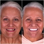 نتيجة قبل وبعد الفينير في DentVisit — Istanbul Dental Care، تجميل ابتسامة لسيدة