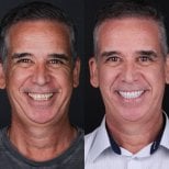 نتيجة قبل وبعد الفينير في DentVisit — Istanbul Dental Care، تجميل الابتسامة
