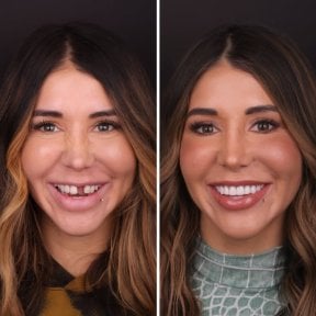 نتيجة قبل وبعد الفينير في DentVisit — Istanbul Dental Care، تحول الابتسامة