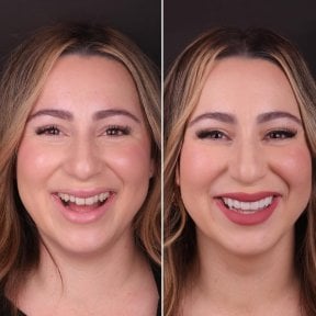 نتيجة قبل وبعد الفينير في DentVisit — Istanbul Dental Care، تحول الابتسامة