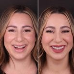 نتيجة قبل وبعد الفينير في DentVisit — Istanbul Dental Care، تحول الابتسامة