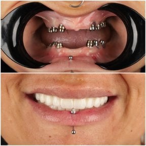 نتائج قبل وبعد زراعة الأسنان في DentVisit — Istanbul Dental Care، استعادة الابتسامة الكاملة