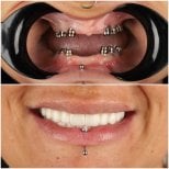 نتائج قبل وبعد زراعة الأسنان في DentVisit — Istanbul Dental Care، استعادة الابتسامة الكاملة