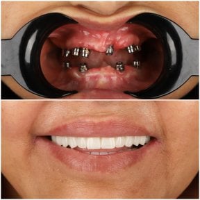 نتائج زراعة الأسنان قبل وبعد في DentVisit — Istanbul Dental Care، ابتسامة مستعادة