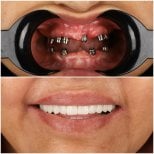 نتائج زراعة الأسنان قبل وبعد في DentVisit — Istanbul Dental Care، ابتسامة مستعادة