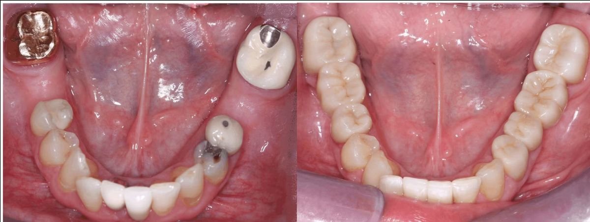 نتائج قبل وبعد جسر الأسنان الزركوني في SoftDentalCare Clinic، ترميم الأسنان السفلية