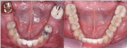 Résultats avant/après bridge dentaire zircone à SoftDentalCare Clinic, restauration dentaire