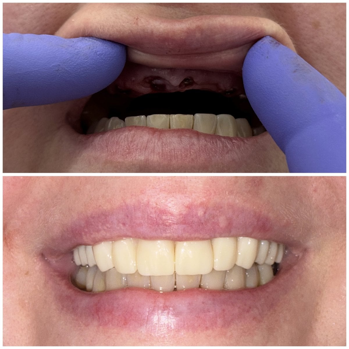 Resultado antes y después de implantes All-on-6 en Spanderashvili Dental Clinic, restauración de sonrisa