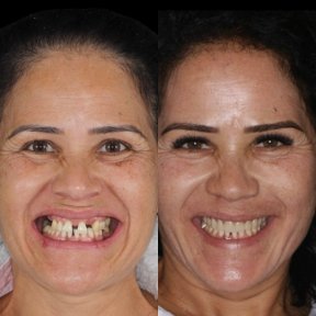 before-after photo all-on-6-dental-implants