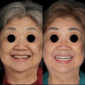 before-after photo all-on-6-dental-implants