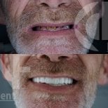 Before and after Zirconia All-on-4 dental implants result at Nifa Dent International clinic