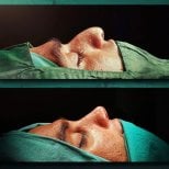 نتائج عملية تجميل الأنف قبل وبعد في Grand Clinic، تحسين شكل الأنف والملف الجانبي