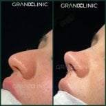 Resultado de rinoplastia antes y después en Grand Clinic, mejora de forma y perfil nasal