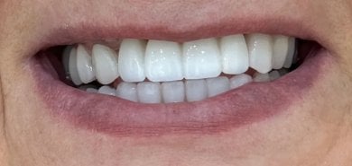 before-after photo all-on-6-dental-implants