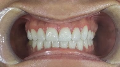 before-after photo all-on-4-dental-implants
