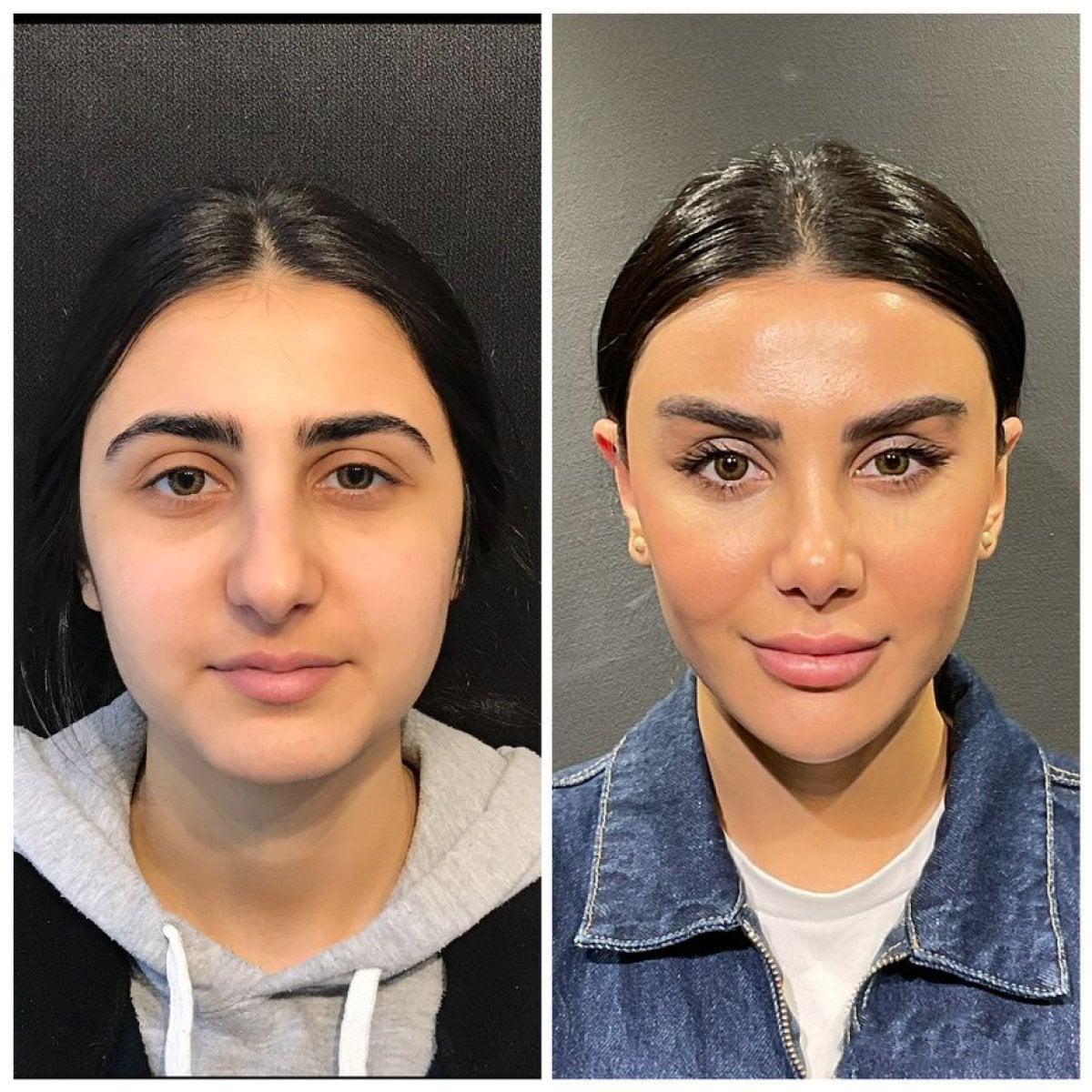 Resultados antes y después de lifting de cejas en Prof. Dr. Furkan Karabekmez Ankara